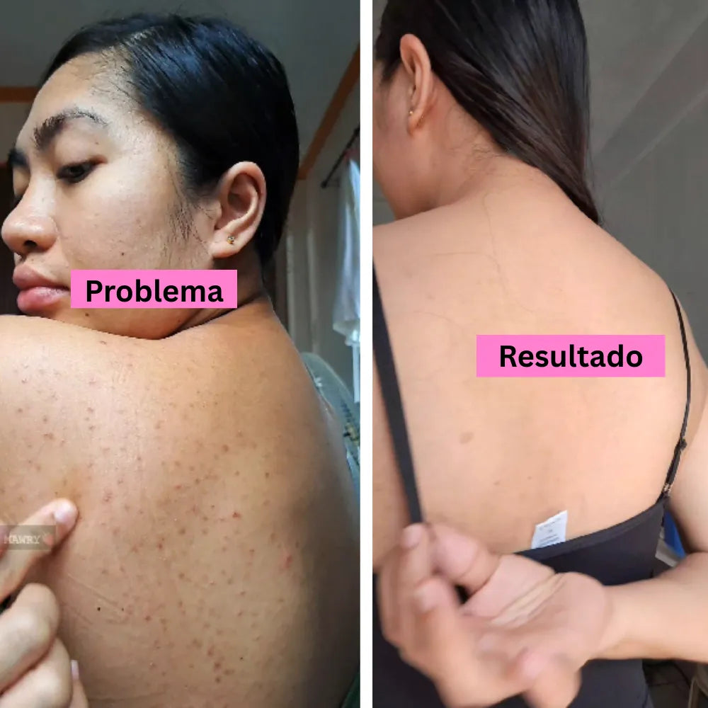 BACK ACNE Elimina el acné corporal