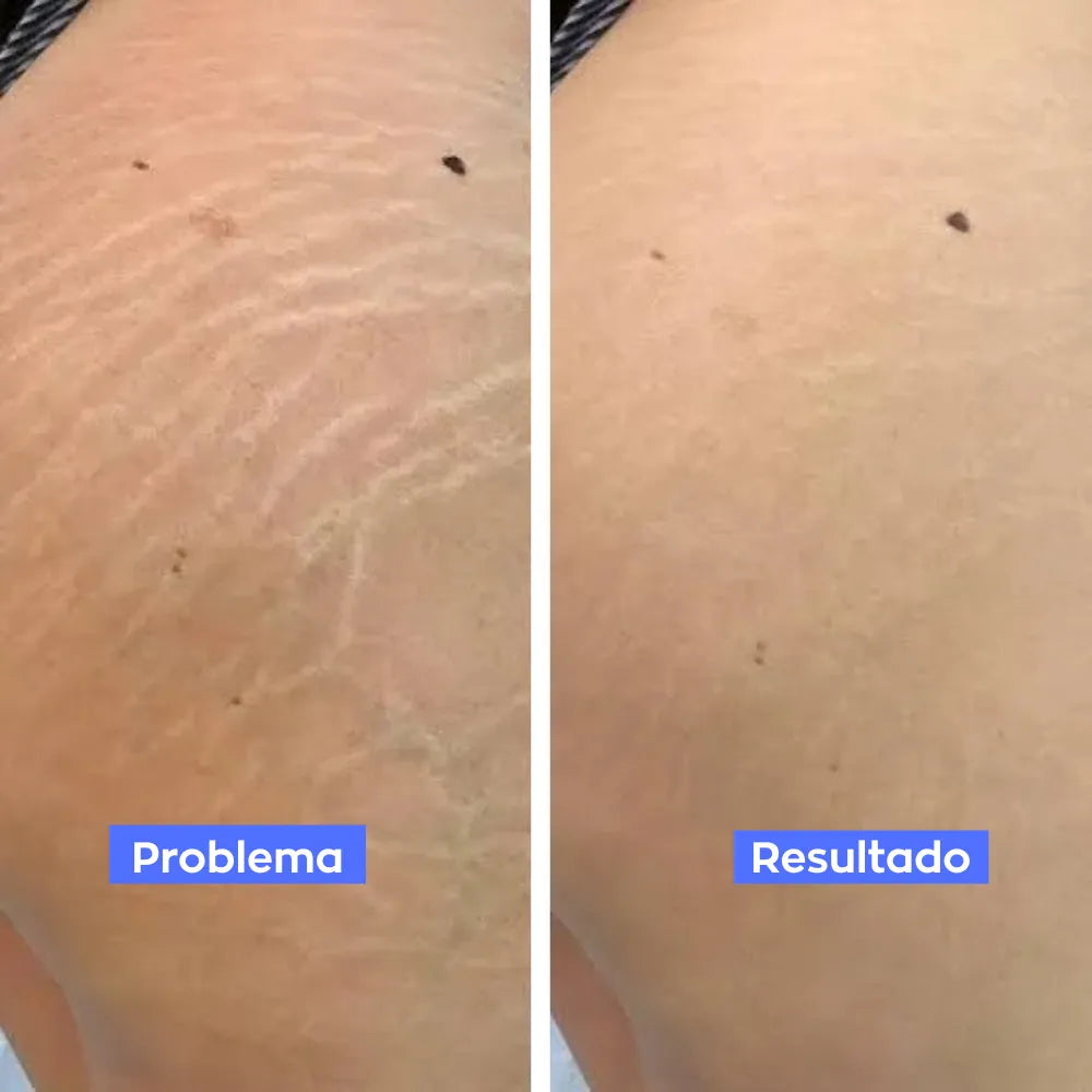 Reductor de Estrías y Celulitis