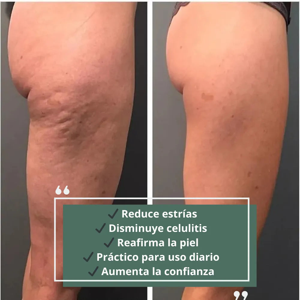 Reductor de Estrías y Celulitis