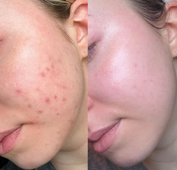 Combo antiacné rostro y espalda