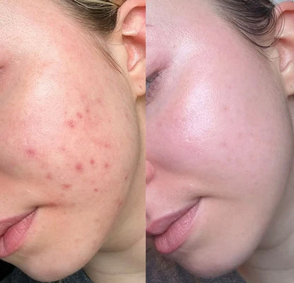 Combo antiacné rostro y espalda