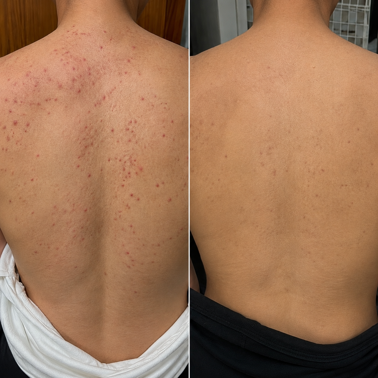 Combo antiacné rostro y espalda