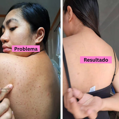 BACK ACNE Elimina el acné corporal