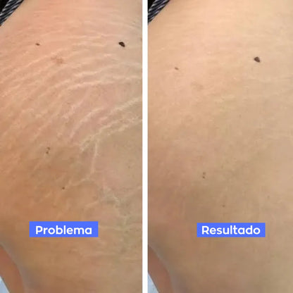 Reductor de Estrías y Celulitis