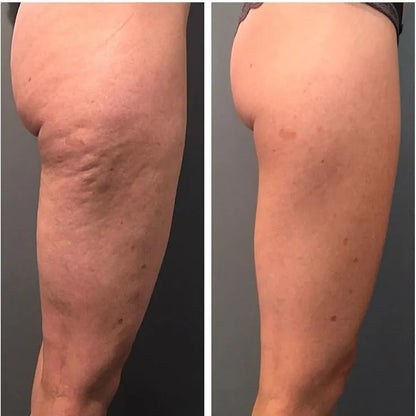 Reductor de Estrías y Celulitis premium